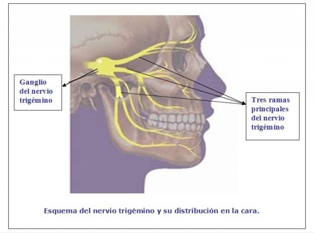 ganglio-trigemino