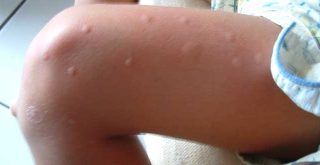 Picaduras de mosquito en pierna