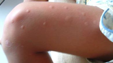 Picaduras de mosquito en pierna