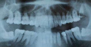 Radiografia de la dentadura humana