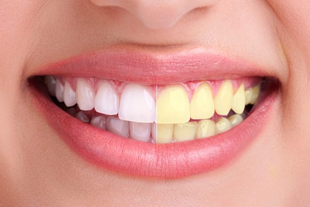 El truco del papel de alumino para blanquear tus dientes