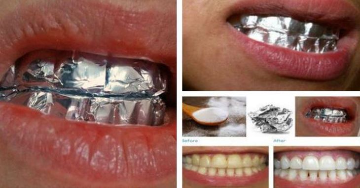 El truco del papel de aluminio para blanquear los dientes